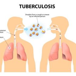 Tb tuberculosis causes symptoms know safe keep family do