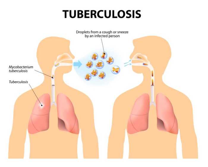 Tb tuberculosis causes symptoms know safe keep family do