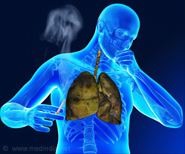 Tuberculosis tb ray chest manual